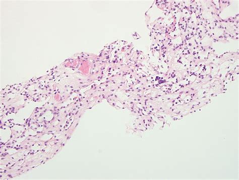 Pathology Outlines Anastomosing Hemangioma