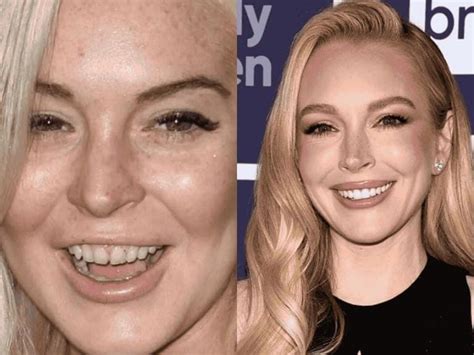 🦷 Lindsay Lohan New Teeth Now Beforeafter In 2025 Lema