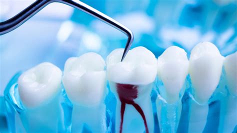 Qu Es Una Endodoncia Gu A Completa Cl Nica La Victoria