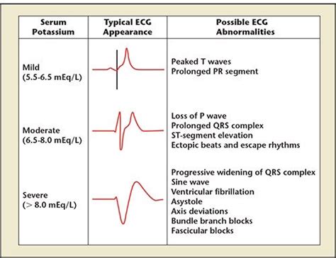 Hyperkalemia Ekg