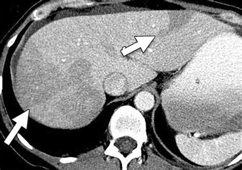 Imaging Findings Of Congestive Hepatopathy Radiographics