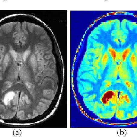 Example of an MRI report showing the presence of tumor in brain with ...