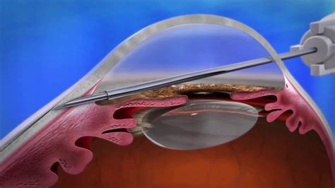 Understanding Glaucoma Types Causes Symptoms And Treatment Options