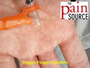 Trigger Finger Injection - Technique and Tips - The Pain Source - Makes Learning About Pain ...