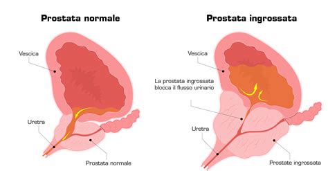 Trattamento Chirurgico Dell Iperplasia Prostatica Benigna EMS Urology