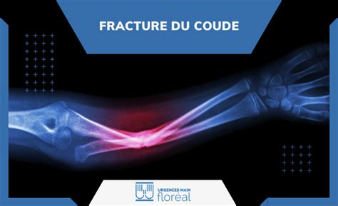 Fracture du coude Symptômes Traitement