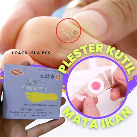 Jual Plester Kutil Mata Ikan Kaki Kapalan Ji Yan Gao Obat Kutil Kapalan