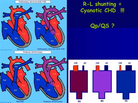 congenital heart lesions   left shunts powerpoint