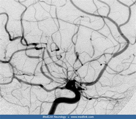 Reversible Cerebral Vasoconstriction Syndromes Medlink Neurology