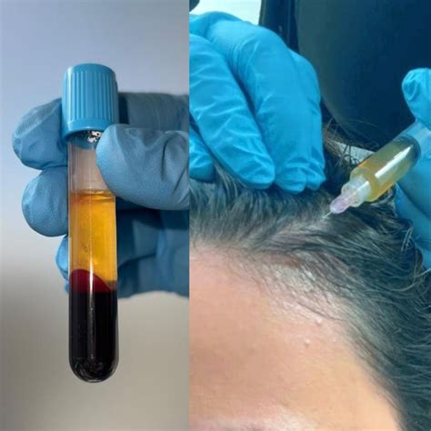 O Que É Prp Capilar - PRP Capilar en WAM Center: Rejuvenece tu Cabello en Santiago