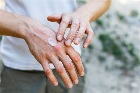 Skuteczne leczenie atopowego zapalenia skóry AZS staje się