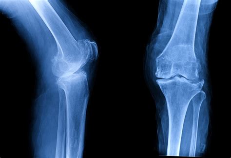 Osteoporosis Of Knee Human Anatomy