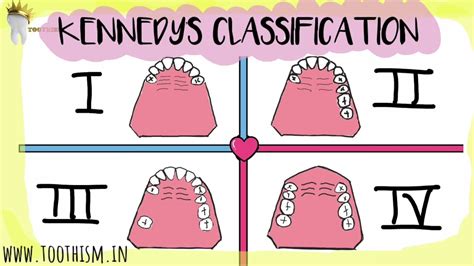 Kennedys Classification And Applegates Rules Prosthodontics Youtube