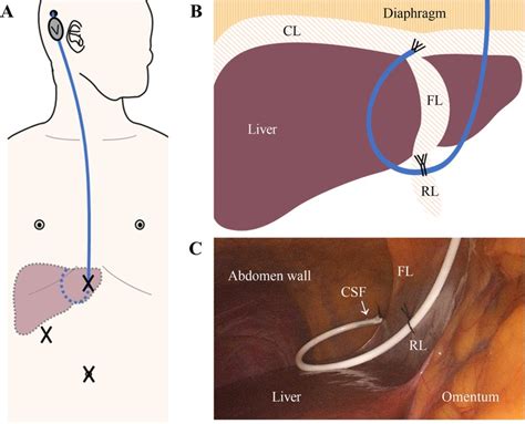 Frontiers Two Point Fixation Enhanced The Outcome Of Laparoscopy