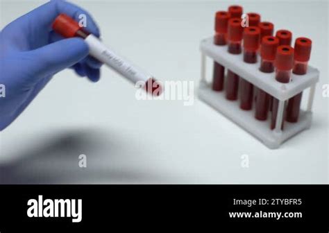 Beta Hcg Test Doctor Showing Blood Sample In Tube Lab Research