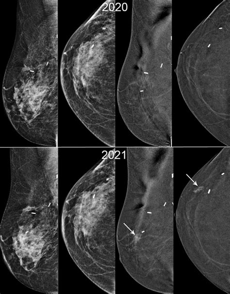 Contrast Enhanced Mammography For Surveillance In Women With A Personal