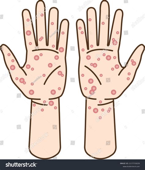 156 Syphilis Rash Images, Stock Photos & Vectors | Shutterstock