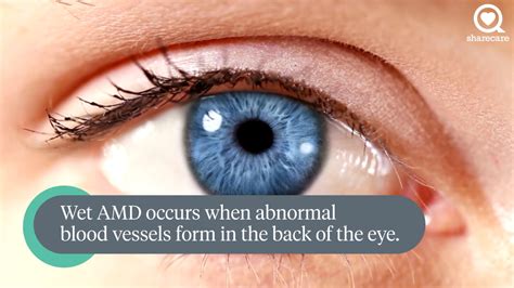 understanding wet amd sharecare