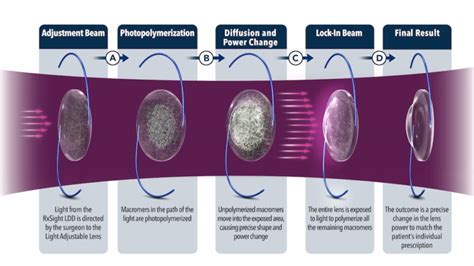 RxSight Light Adjustable Lens in San Francisco Bay Area