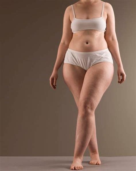 LIPEDEMA Come Riconoscerlo E Trattarlo Efficacemente