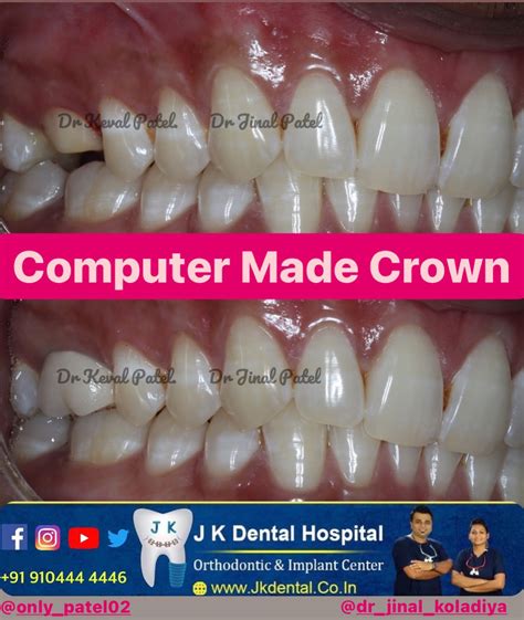 Cad cam crown is ready to get cemented into the mouth. They are precise