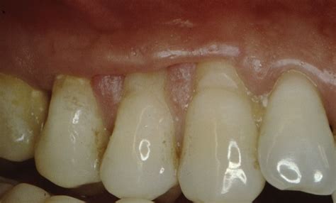 Récession Gingivale Et Dénudation Radiculaire Avec Début Dencoche Dans