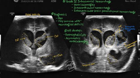 Case 32: Grade IV Intracranial Hemorrhage ~ Imaging Study