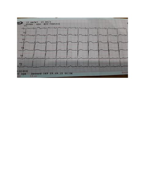 Pdf Gambar Ekg Dokumen Tips