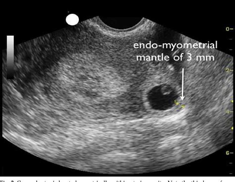 Figure 2 From Modern Management Of Cornual Ectopic Pregnancy Semantic Scholar