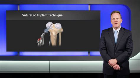 Arthrex The Evolution Of All Soft Tissue Meniscal Allograft