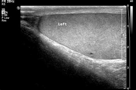 Testicular Torsion Image