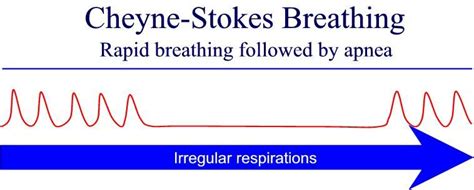 Cheyne Stokes Respirations Are Described as a