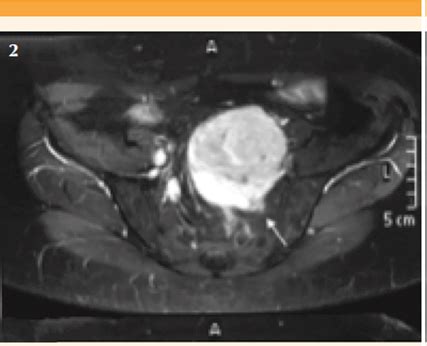 Schwannoma P Lvico Retroperitoneal Que Simula Un Leiomioma Reporte De