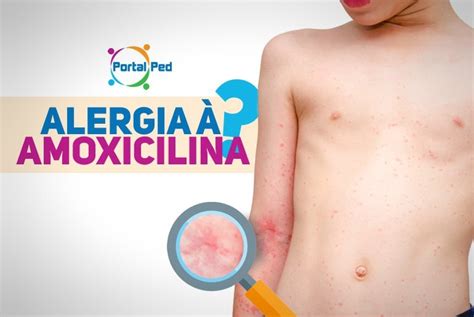 Alergia à Amoxicilina Penicilina é realmente alergia PortalPed