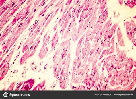 Heart Hypertrophy Photomicrograph Stock Photo Katerynakon