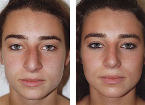 Rhinoplasty Before And After Nose Job Before And After