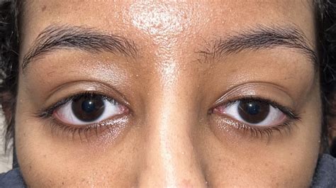 1 Upper Eyelid Surgery Before And After Photos Dallas Plano Texas Cosmetic Reconstructive