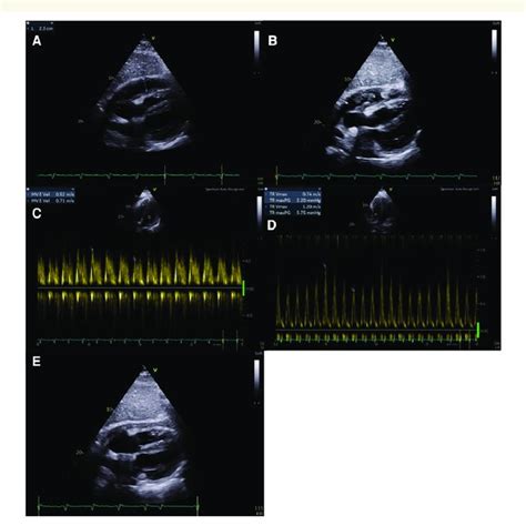 Admission transthoracic echocardiography demonstrating tamponade ...