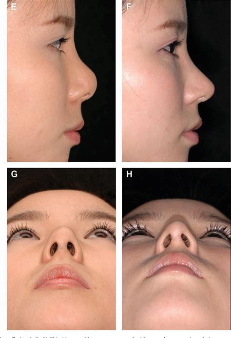 Figure 1 From Correction Of The Supratip Deformity Of The Nose