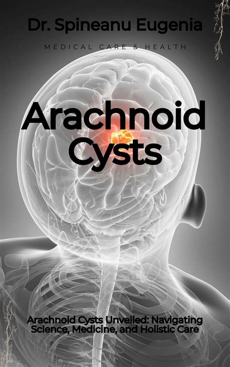 Arachnoid Cysts Comprehensive Guide To Causes Symptoms Diagnosis And Advanced Treatments For