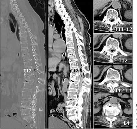 Figure 1 From Whole Lumbar Spinal Subdural Hematoma With Progressive