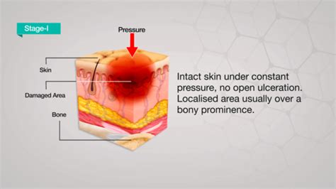 Pressure Ulcer Causes Stages Treatment Axio Biosolutions