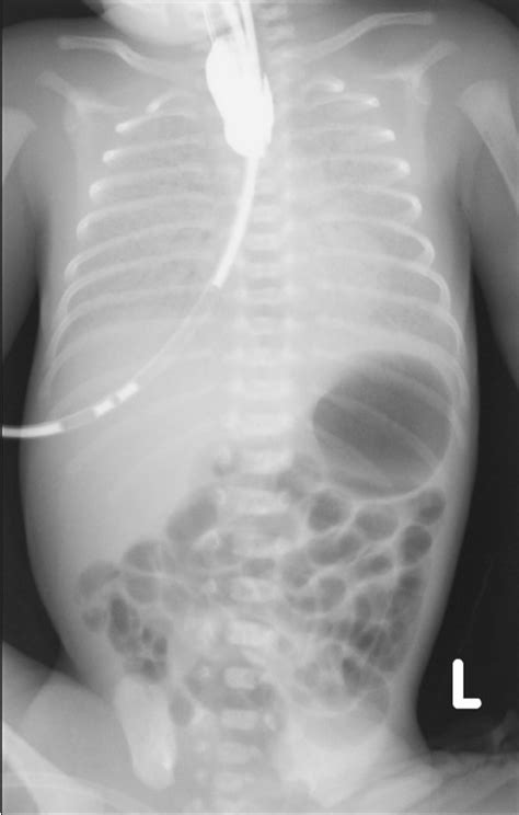 Esophageal Atresia With Fistula