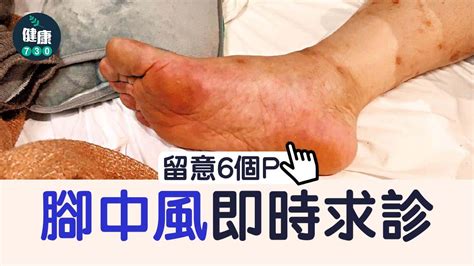 中風｜留意6個p 腳中風即時求診 Am730