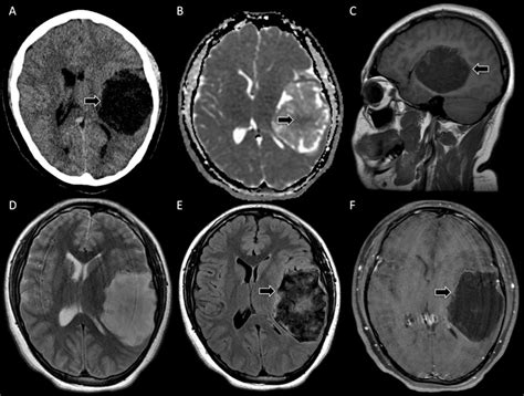 Atypical Presentation Of Large Intracranial Epidermoid Tumour In A