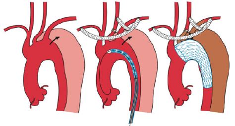 Endovascular Today Expanding The Landing Zone For Tevar November 2016