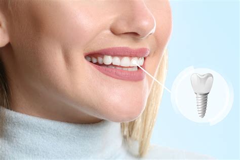 Should Sedation Dentistry Be Used For Full Mouth Dental Implant