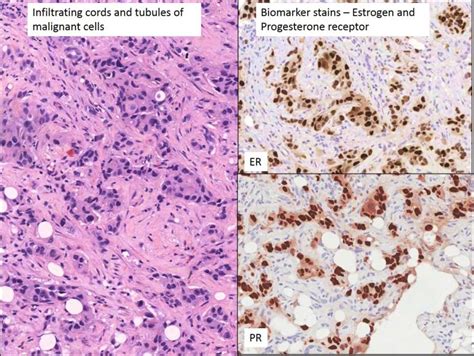 Pathology In Action A Breast Lump Nus Pathweb Nus Pathweb