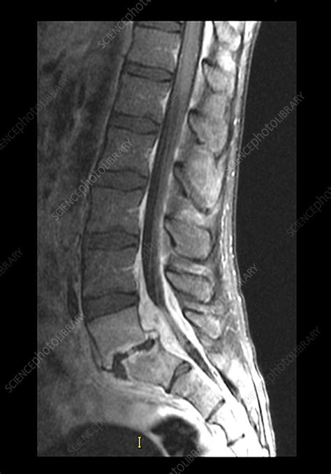 Epidural Abscess Mri Lumbar