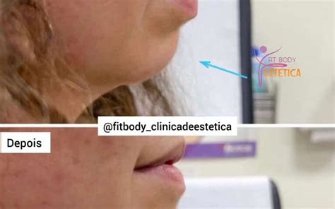 Harmonização do Mento Antes e Depois Clínica Fit Body Estética